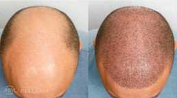 Hair transplantation in Turkey, Istanbul, 2100 Euros with VIP pack Hair transplantation in Turkey, Istanbul, 2100 Euros with VIP pack - MM.LV