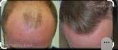 Hair transplantation in Turkey, Istanbul, 2100 Euros with VIP pack - MM.LV - 2